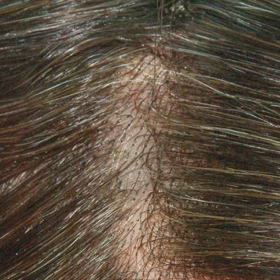 Ljc989 Skin Gause Edge Human Hair Replacement System